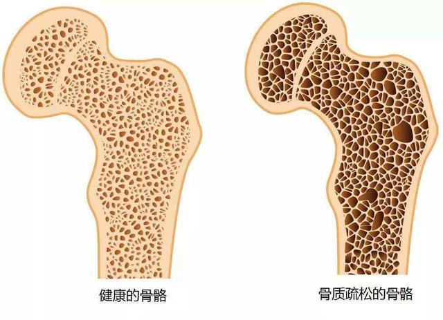 骨質(zhì)疏松癥分為局限型和彌漫型